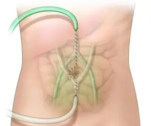 hyperthermic intraperitoneal chemotherapy 1489667 3692454 001 0.psd 300x280