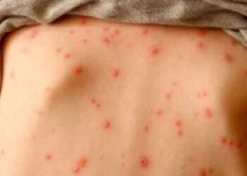 principal sarampion honduras