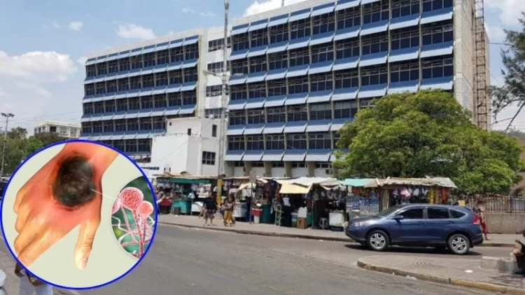 siete muertes por hongo negro en honduras en 2025 incluida una nina de tres anos